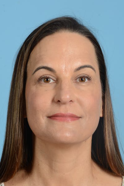 Facial Augmentation Before & After Gallery - Patient 275142 - Image 2