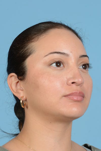 Rhinoplasty Before & After Gallery - Patient 175728 - Image 4