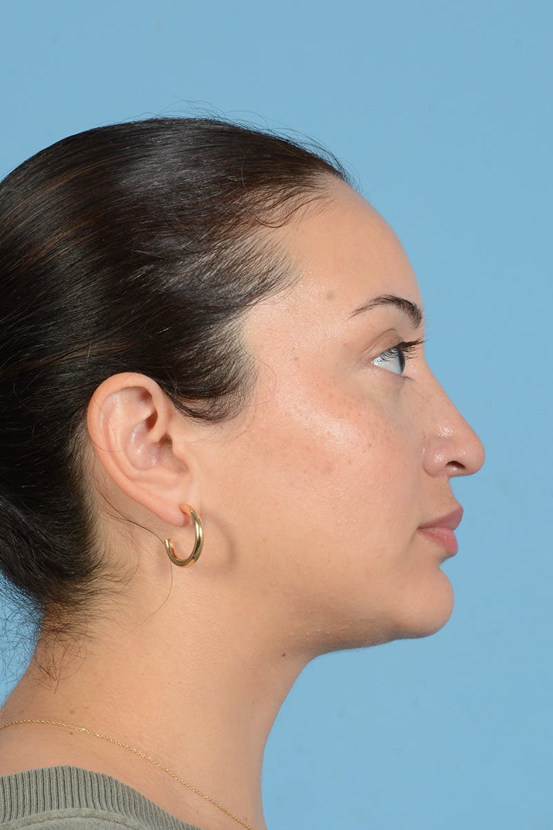 Rhinoplasty Before & After Gallery - Patient 175728 - Image 5