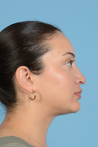 Rhinoplasty Before & After Gallery - Patient 175728 - Image 6