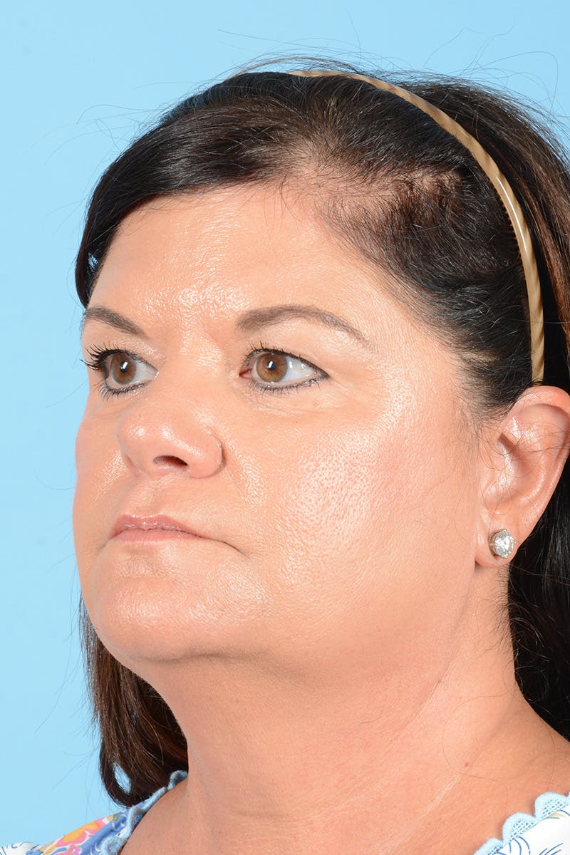 Facelift Before & After Gallery - Patient 214856 - Image 9