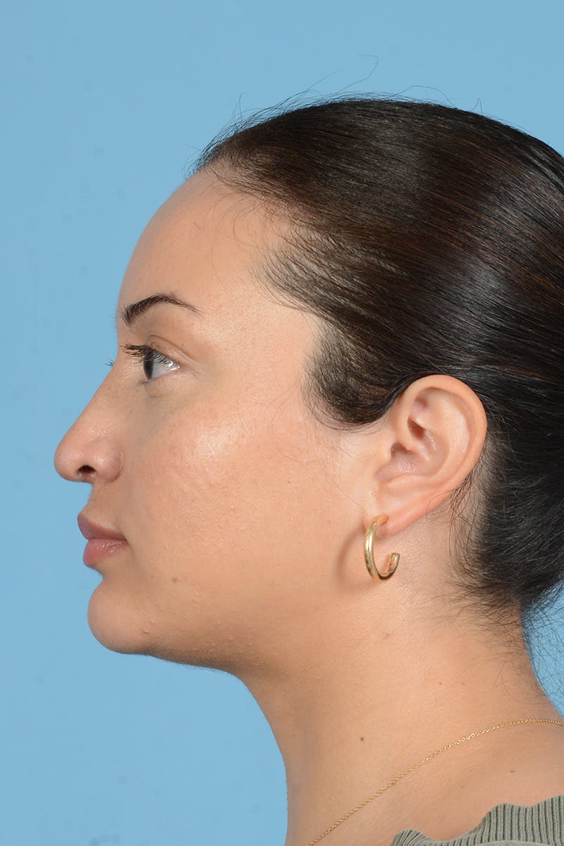 Rhinoplasty Before & After Gallery - Patient 175728 - Image 9