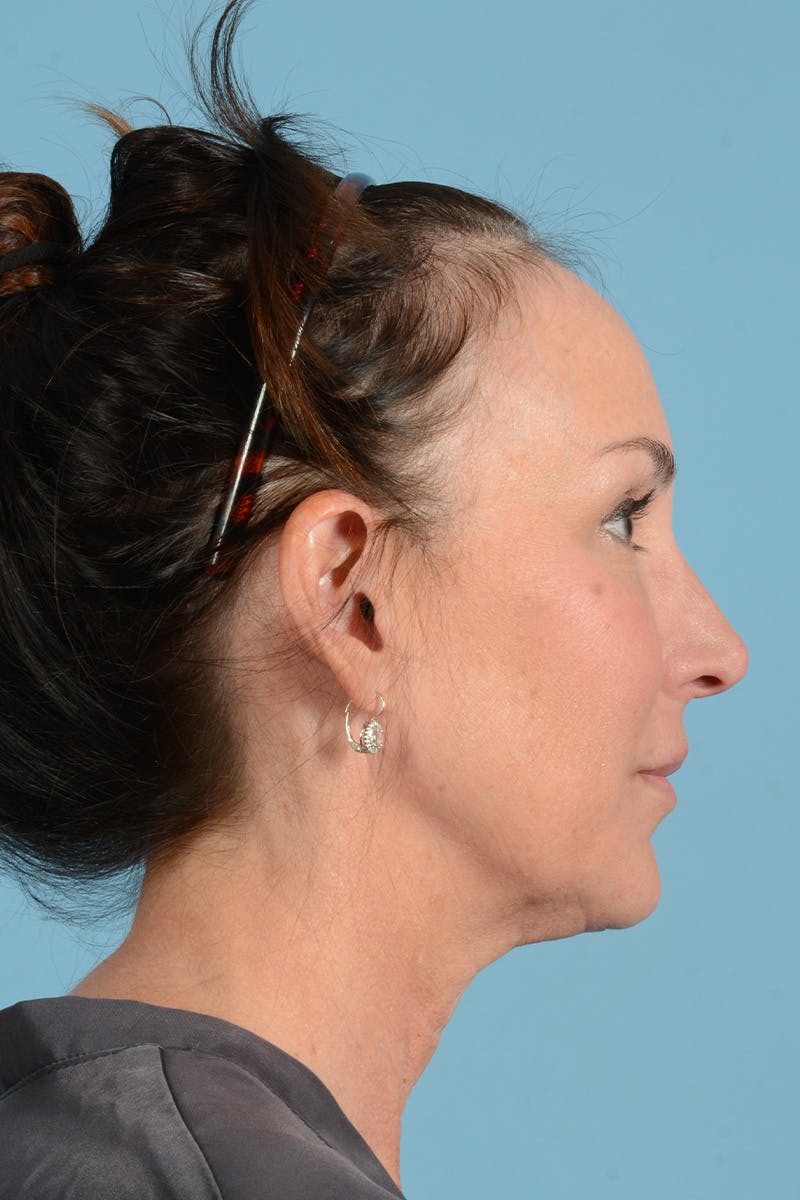 Facial Augmentation Before & After Gallery - Patient 211177 - Image 5