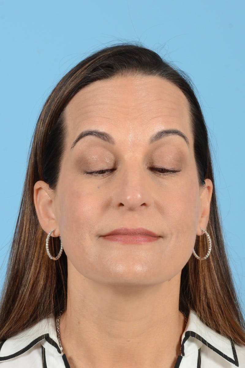 Facial Augmentation Before & After Gallery - Patient 275142 - Image 5