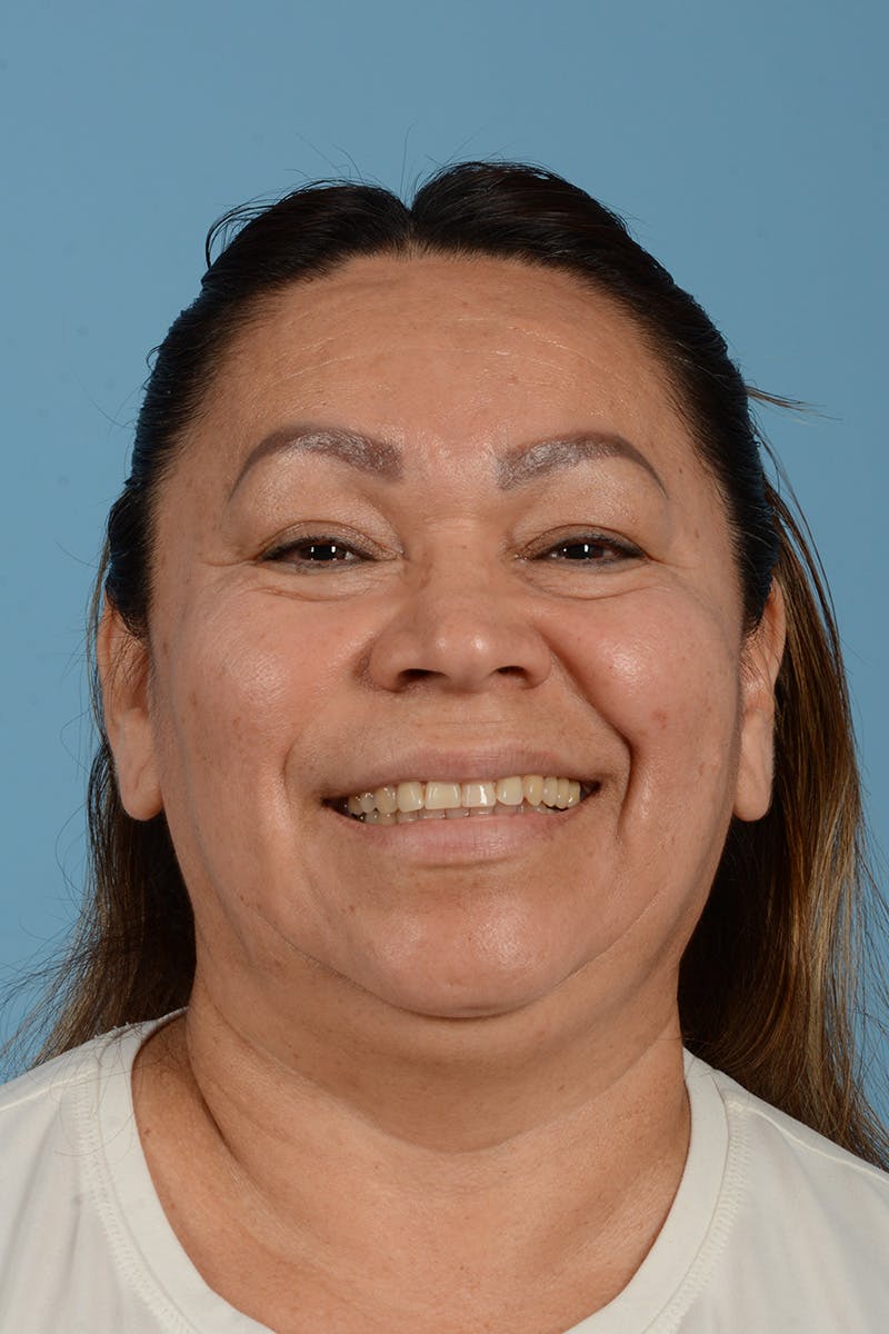 Endoscopic Brow Lift Before & After Gallery - Patient 314786 - Image 3