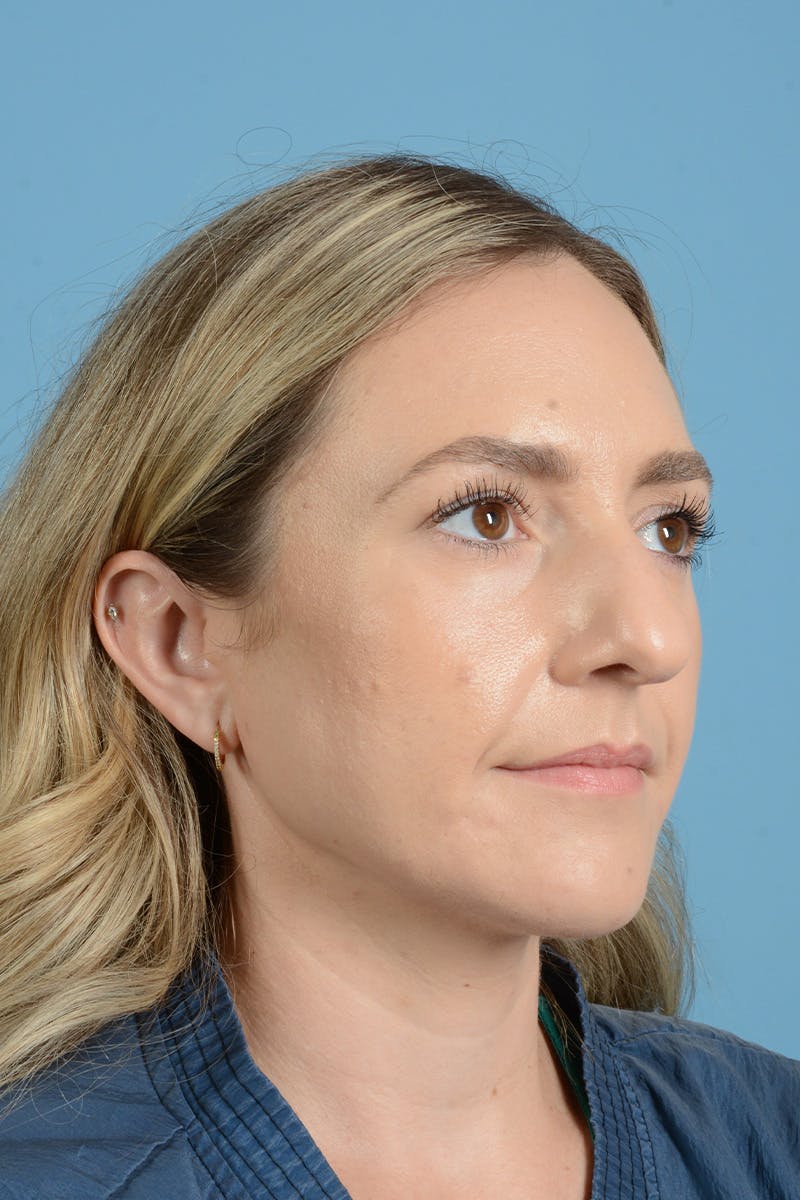 Rhinoplasty Before & After Gallery - Patient 172246 - Image 7