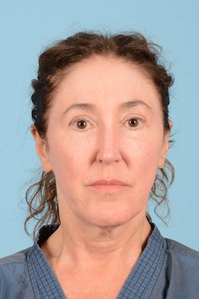 Facelift Before & After Gallery - Patient 339885 - Image 1