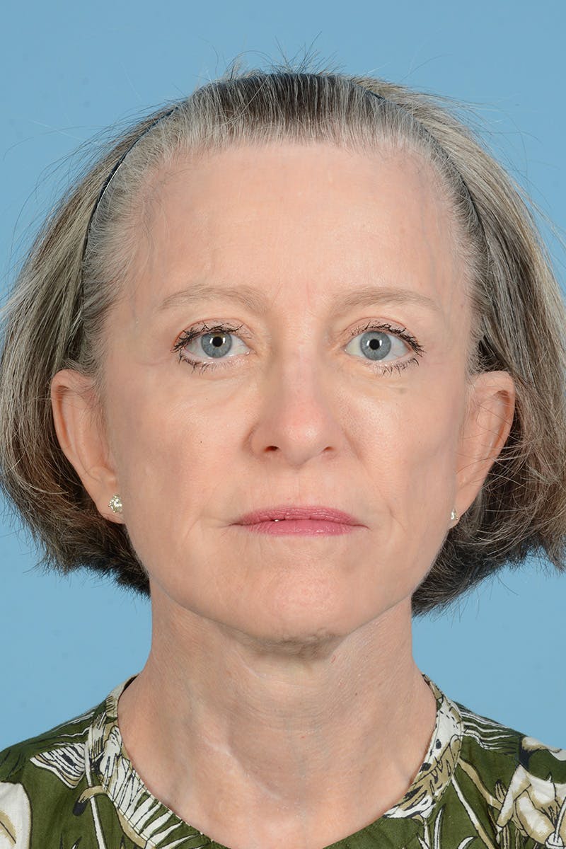 Endoscopic Brow Lift Before & After Gallery - Patient 905420 - Image 2