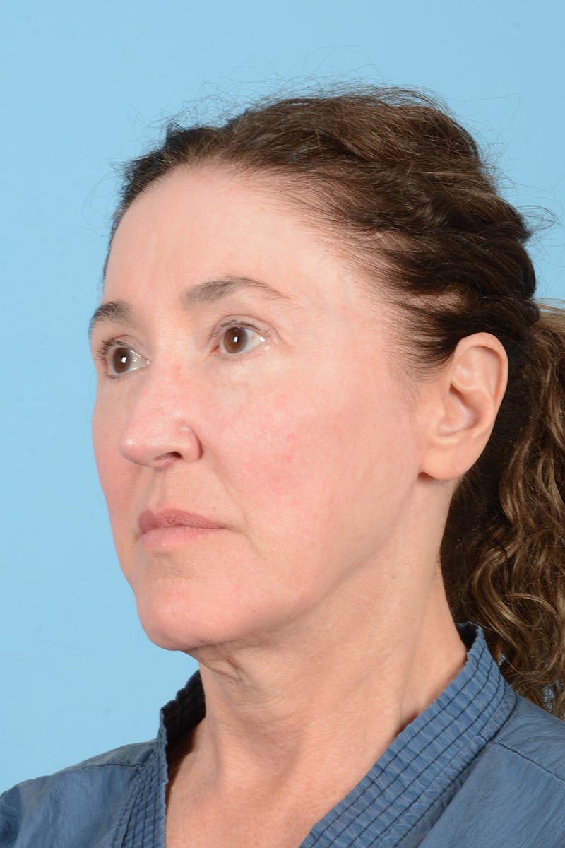 Facelift Before & After Gallery - Patient 339885 - Image 9