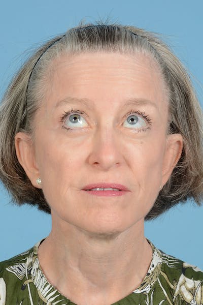 Endoscopic Brow Lift Before & After Gallery - Patient 905420 - Image 6