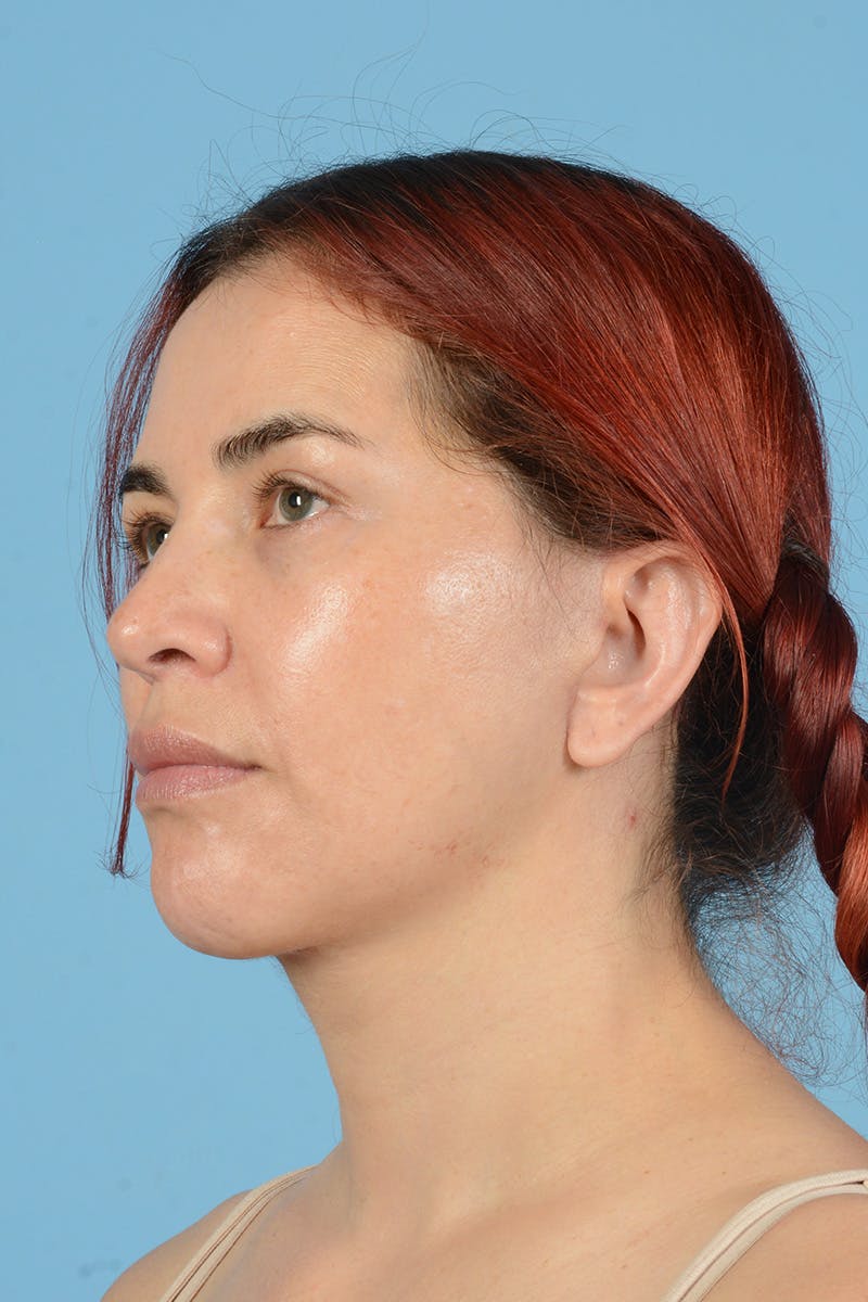 Neck Lift Before & After Gallery - Patient 126947 - Image 8