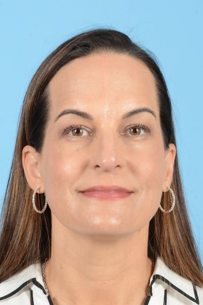 Facial Augmentation Before & After Gallery - Patient 275142 - Image 1