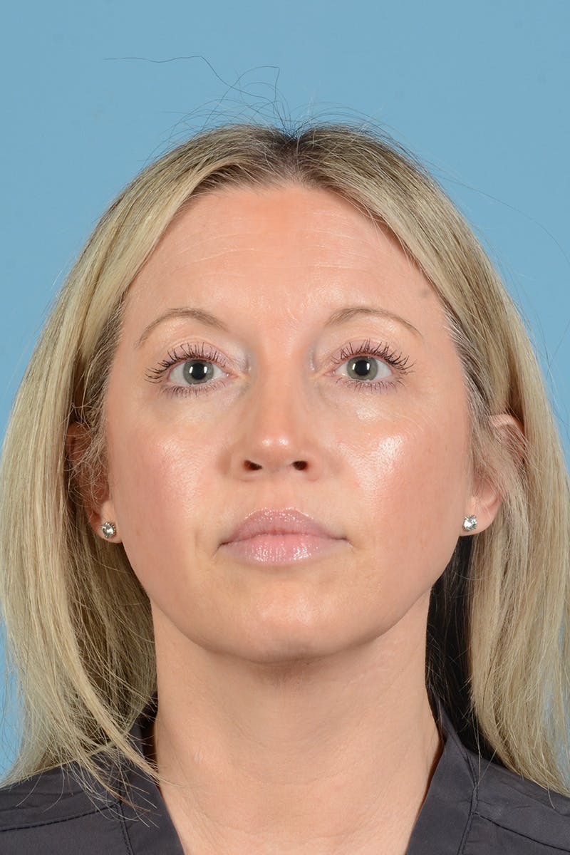 Rhinoplasty Before & After Gallery - Patient 353266 - Image 2