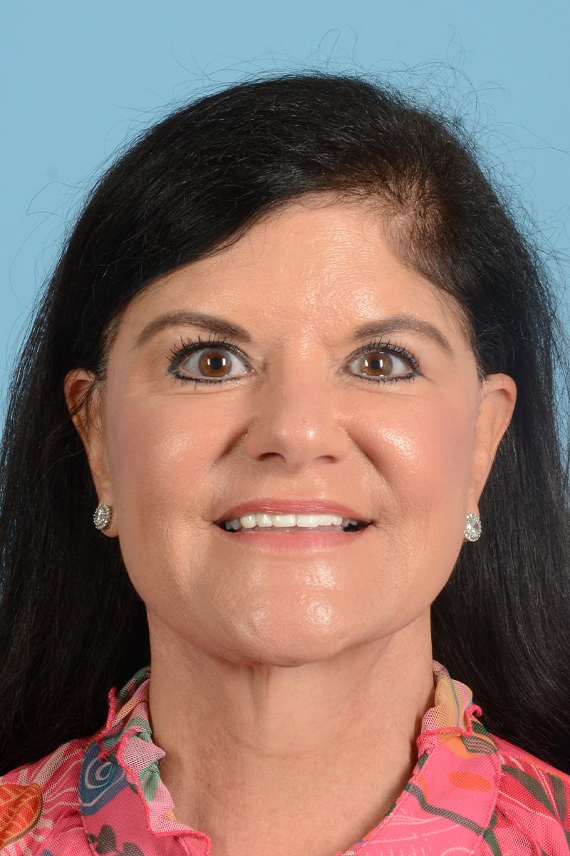 Facelift Before & After Gallery - Patient 214856 - Image 4