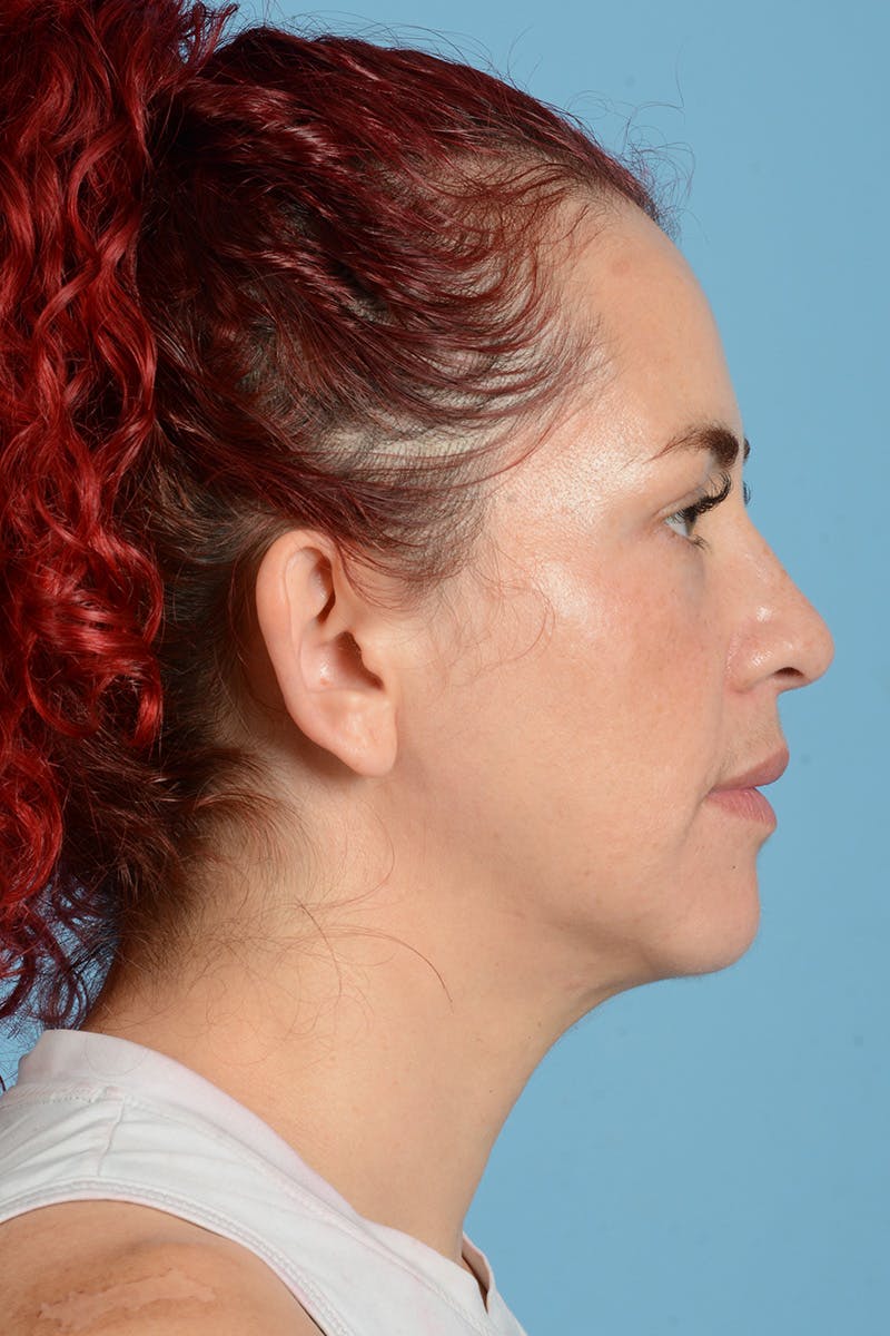 Neck Lift Before & After Gallery - Patient 126947 - Image 5