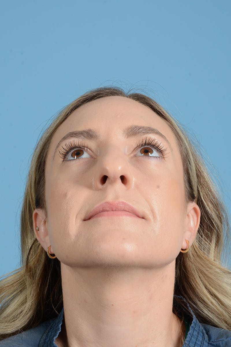 Rhinoplasty Before & After Gallery - Patient 172246 - Image 15