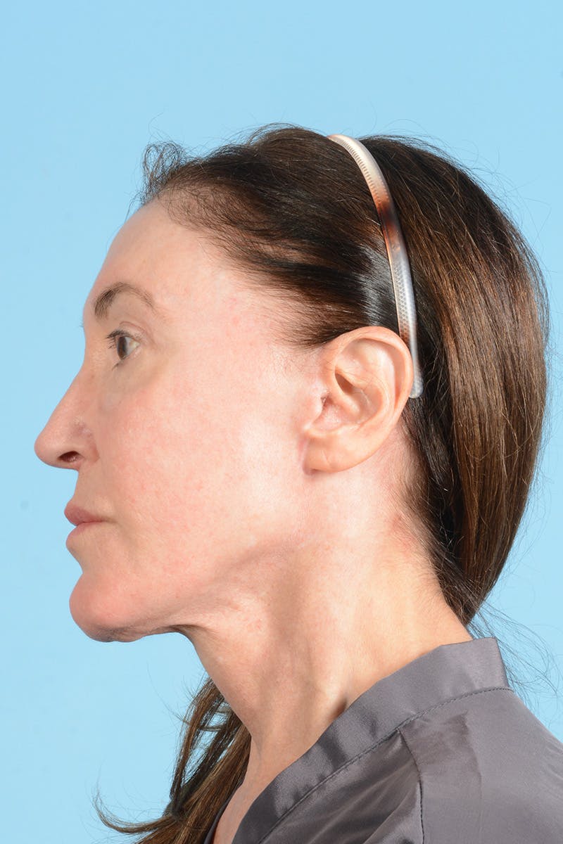 Facelift Before & After Gallery - Patient 339885 - Image 12