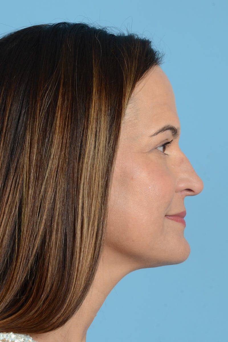 Facial Augmentation Before & After Gallery - Patient 275142 - Image 10