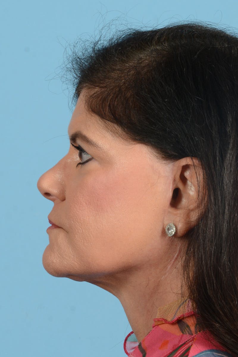 Facelift Before & After Gallery - Patient 214856 - Image 12