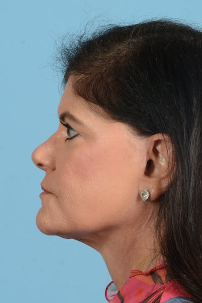 Facelift Before & After Gallery - Patient 214856 - Image 12