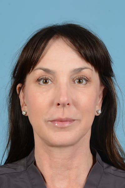 Facial Augmentation Before & After Gallery - Patient 211177 - Image 2