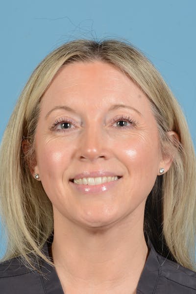 Rhinoplasty Before & After Gallery - Patient 353266 - Image 4