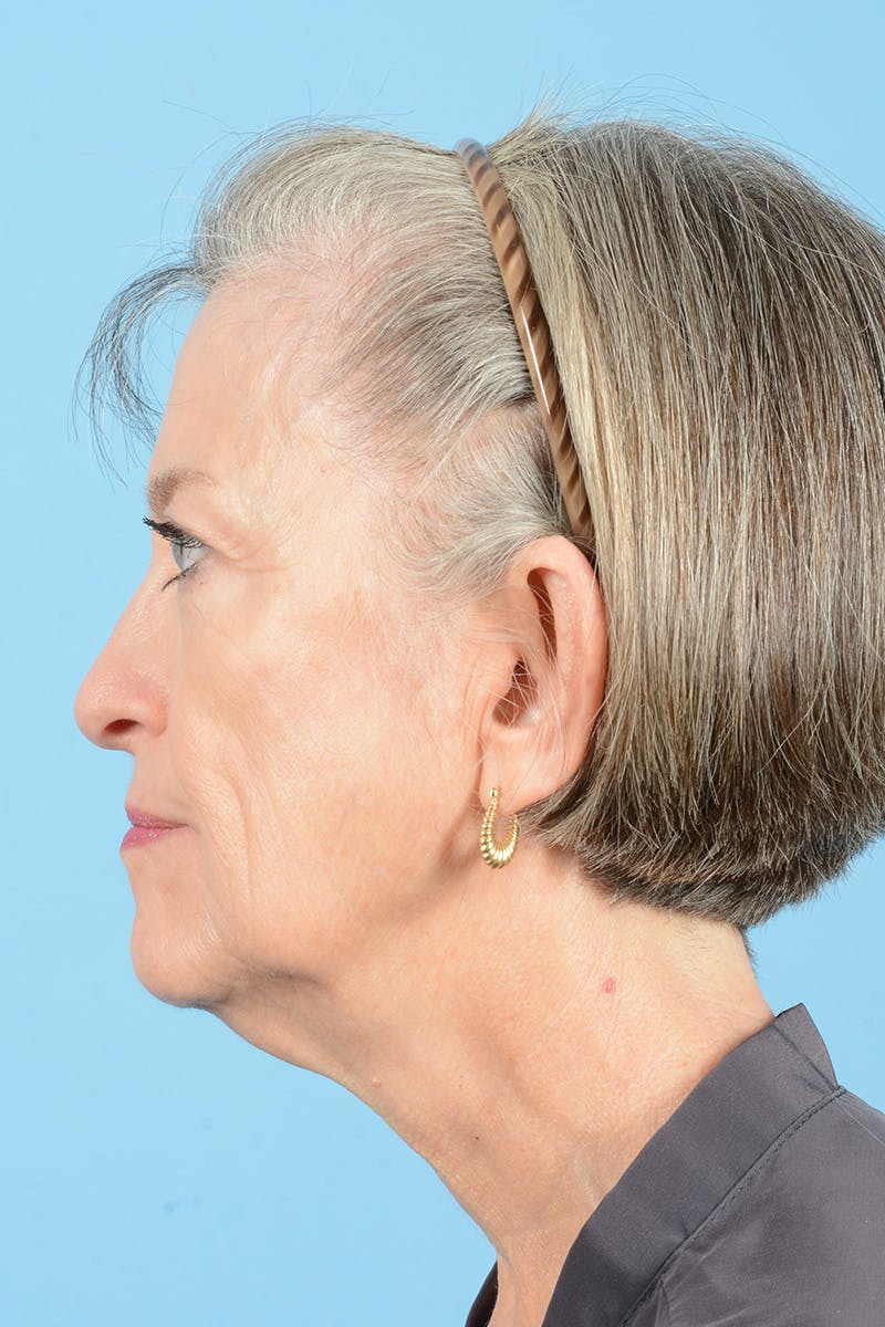 Endoscopic Brow Lift Before & After Gallery - Patient 905420 - Image 13