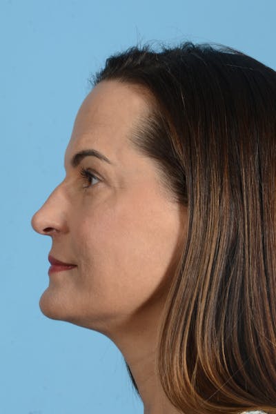 Facial Augmentation Before & After Gallery - Patient 275142 - Image 14