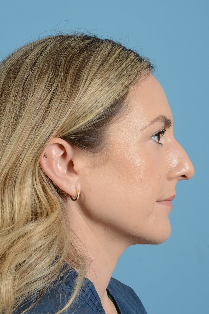 Rhinoplasty Before & After Gallery - Patient 172246 - Image 9