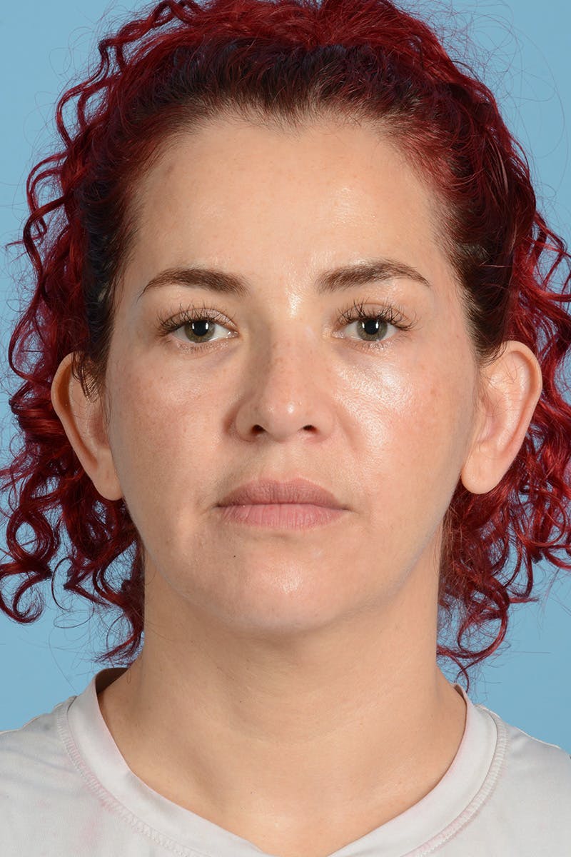 Neck Lift Before & After Gallery - Patient 126947 - Image 1