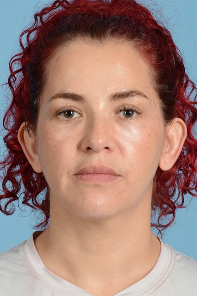 Facelift Before & After Gallery - Patient 414376 - Image 1