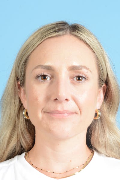 Rhinoplasty Before & After Gallery - Patient 172246 - Image 2