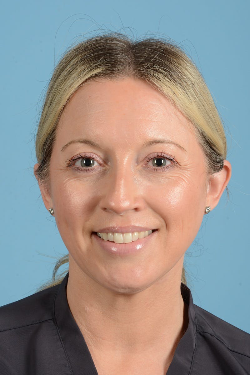 Rhinoplasty Before & After Gallery - Patient 353266 - Image 3