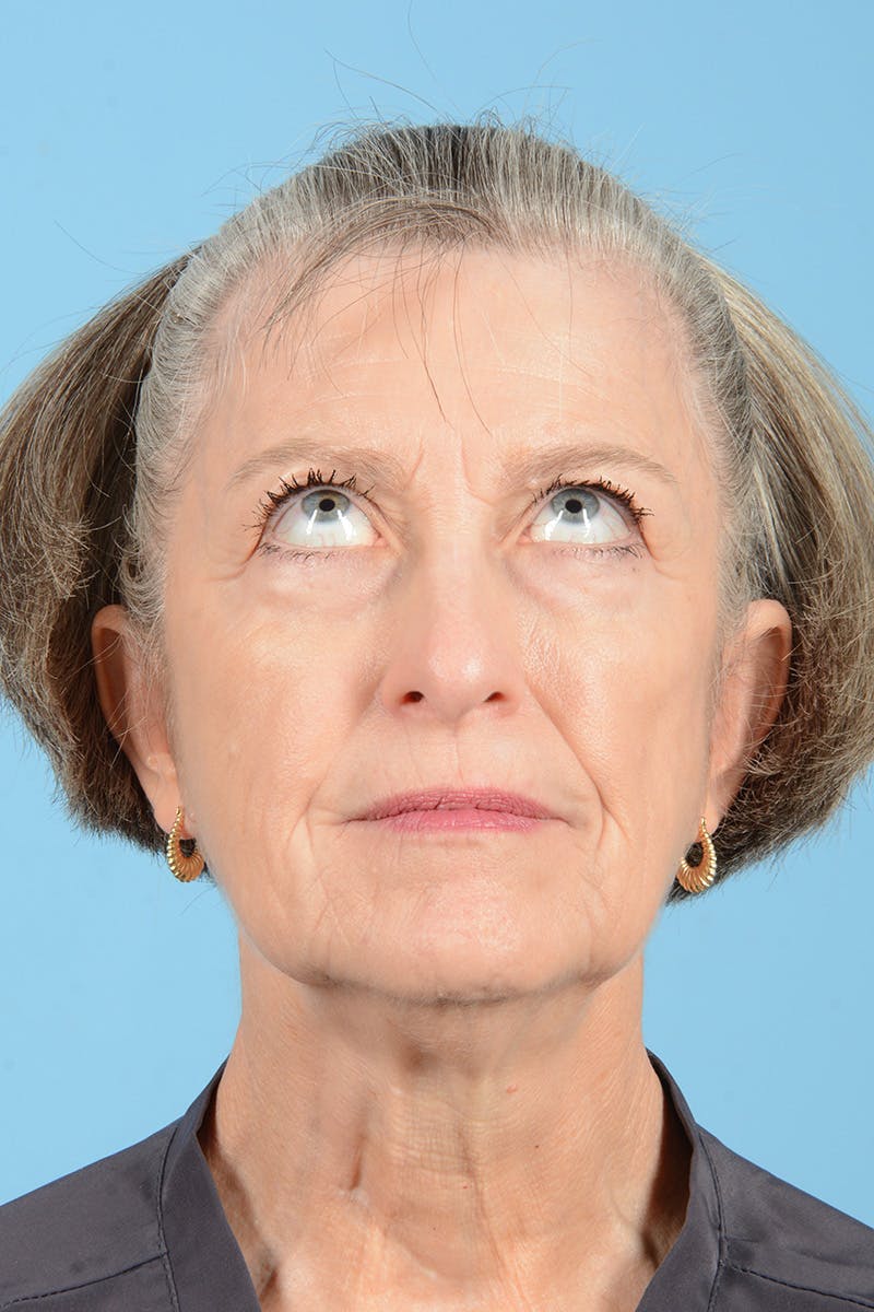 Endoscopic Brow Lift Before & After Gallery - Patient 905420 - Image 5