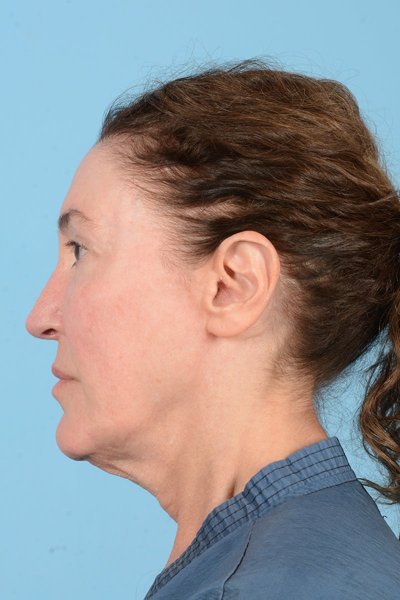 Facelift Before & After Gallery - Patient 339885 - Image 11