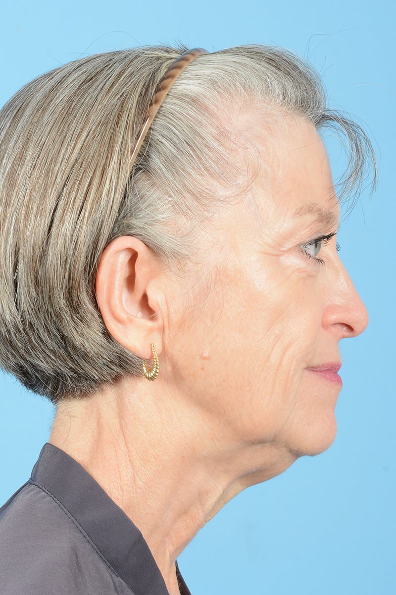 Endoscopic Brow Lift Before & After Gallery - Patient 905420 - Image 9