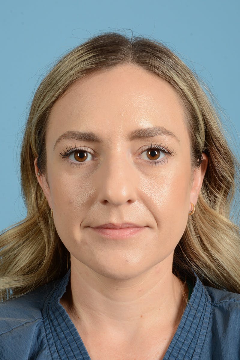 Rhinoplasty Before & After Gallery - Patient 172246 - Image 1