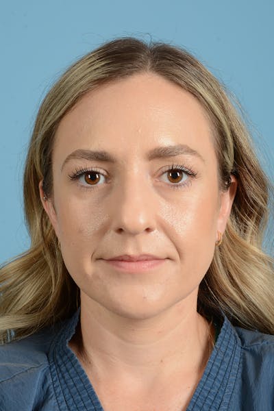 Rhinoplasty Before & After Gallery - Patient 172246 - Image 1