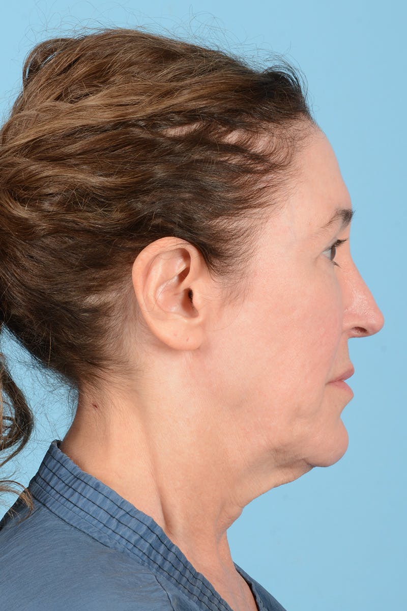 Facelift Before & After Gallery - Patient 339885 - Image 7