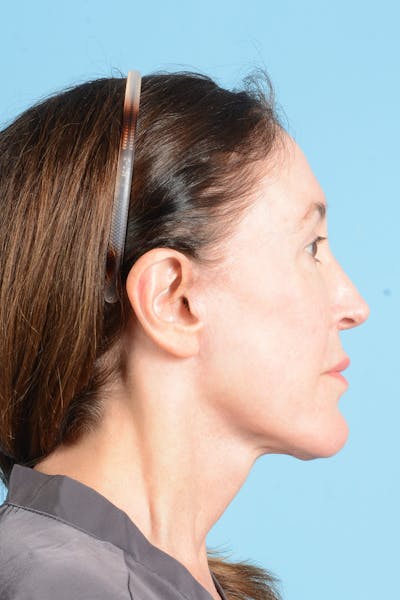 Facelift Before & After Gallery - Patient 339885 - Image 8