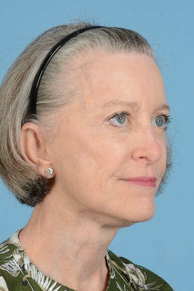Endoscopic Brow Lift Before & After Gallery - Patient 905420 - Image 8
