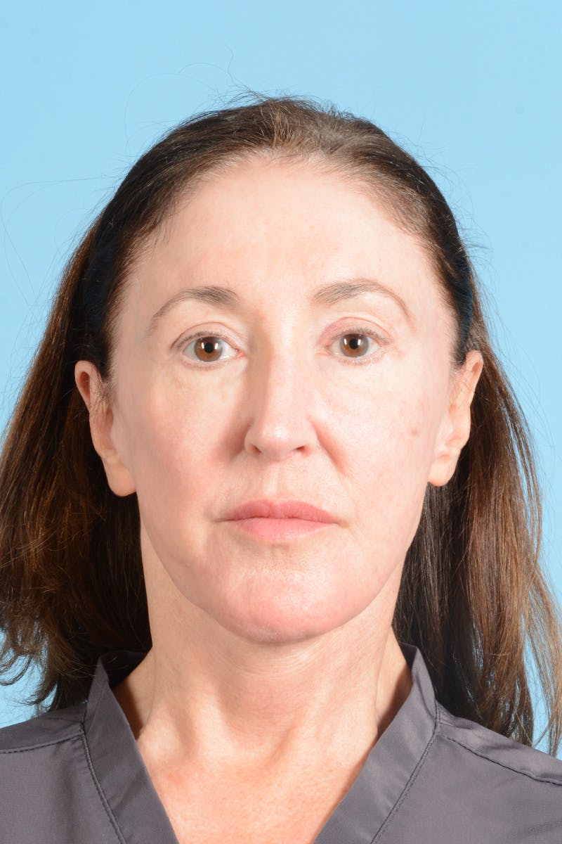 Facelift Before & After Gallery - Patient 339885 - Image 2