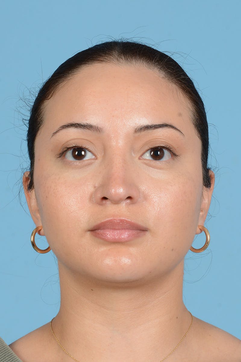 Rhinoplasty Before & After Gallery - Patient 175728 - Image 1