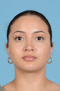 Rhinoplasty Before & After Gallery - Patient 175728 - Image 1