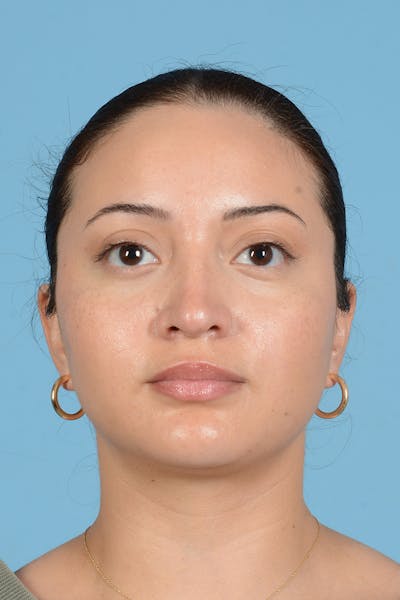 Rhinoplasty Before & After Gallery - Patient 175728 - Image 1