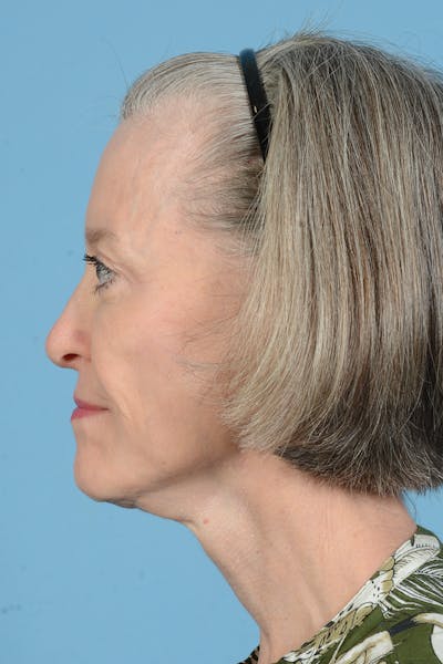 Endoscopic Brow Lift Before & After Gallery - Patient 905420 - Image 14
