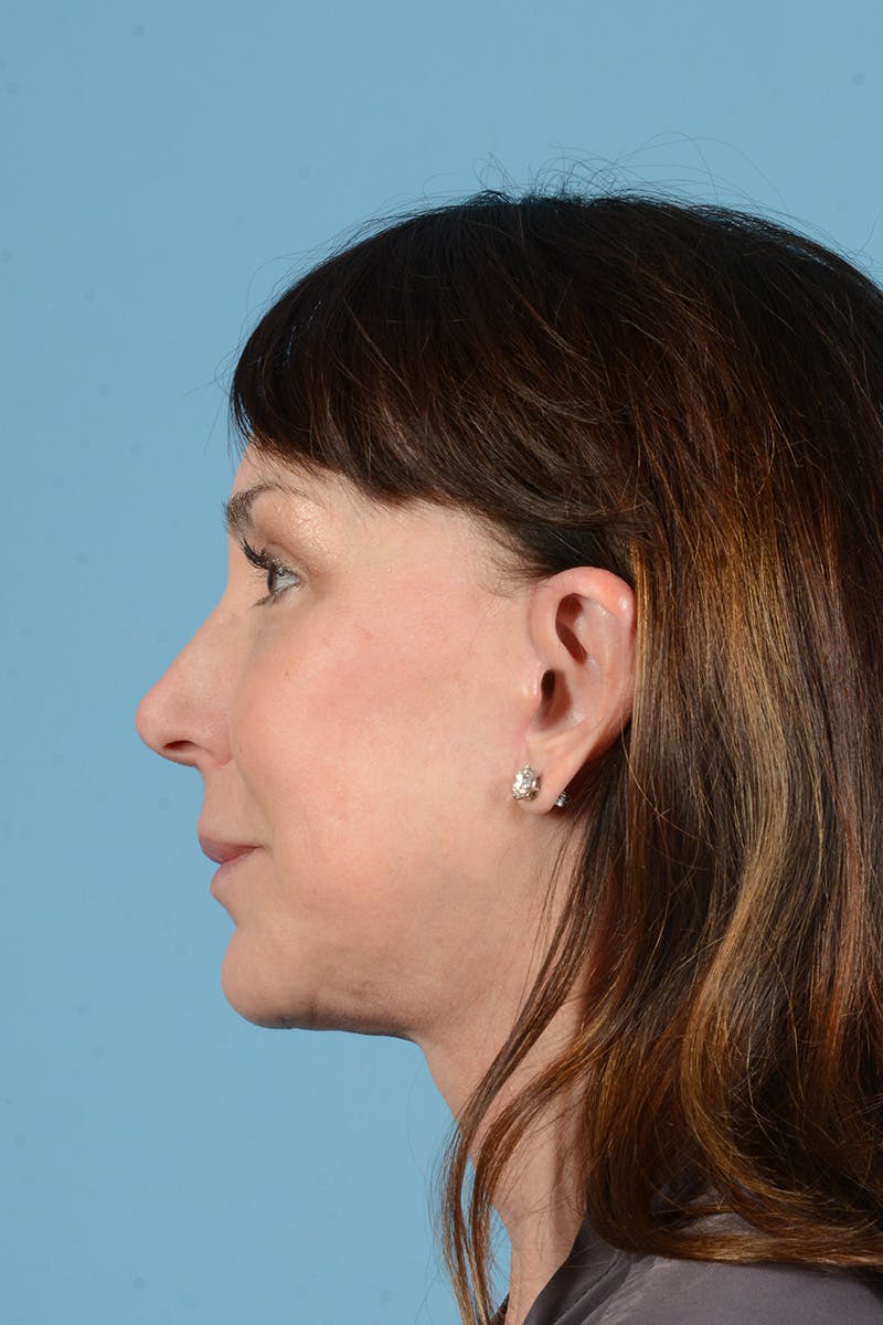Facial Augmentation Before & After Gallery - Patient 211177 - Image 10