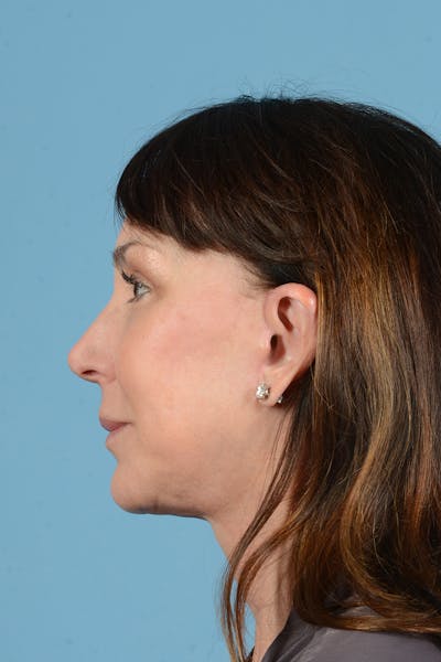 Facial Augmentation Before & After Gallery - Patient 211177 - Image 10
