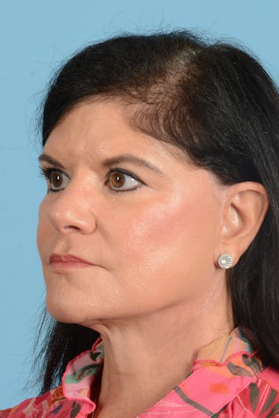 Facelift Before & After Gallery - Patient 214856 - Image 10