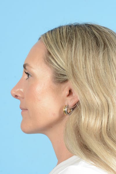 Rhinoplasty Before & After Gallery - Patient 172246 - Image 14